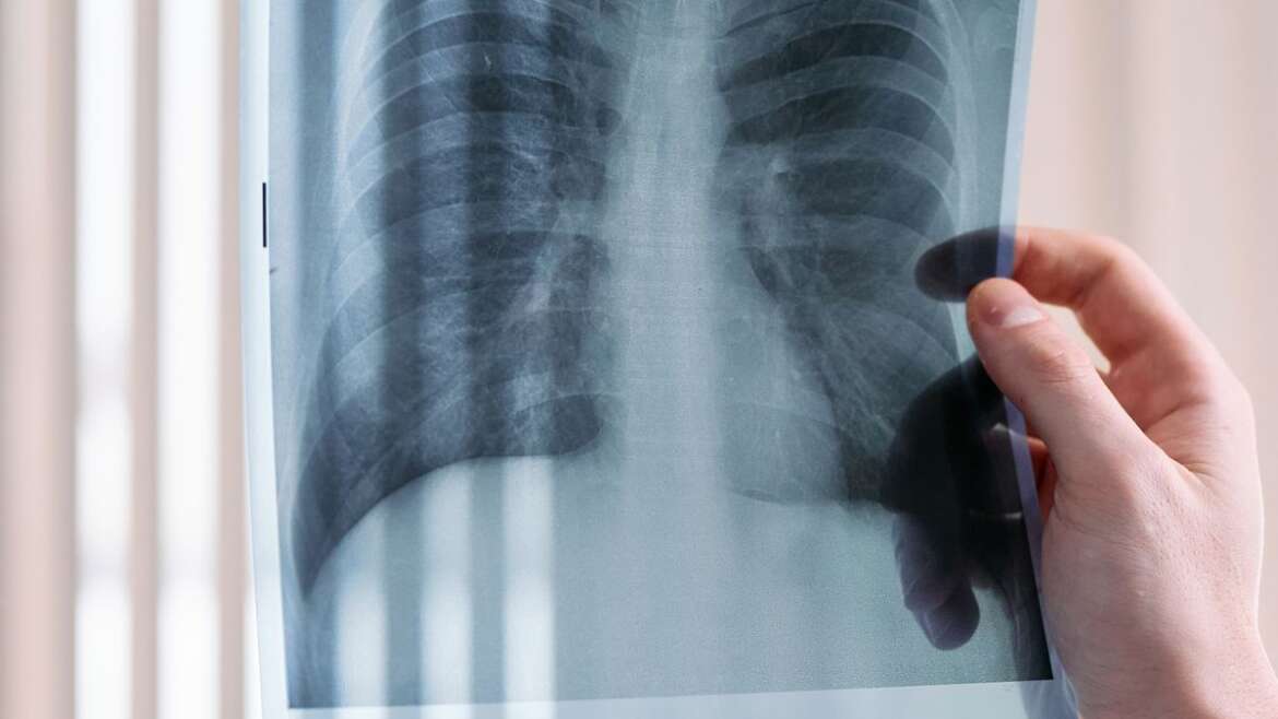 Médico observa radiografia de tórax durante avaliação pulmonar