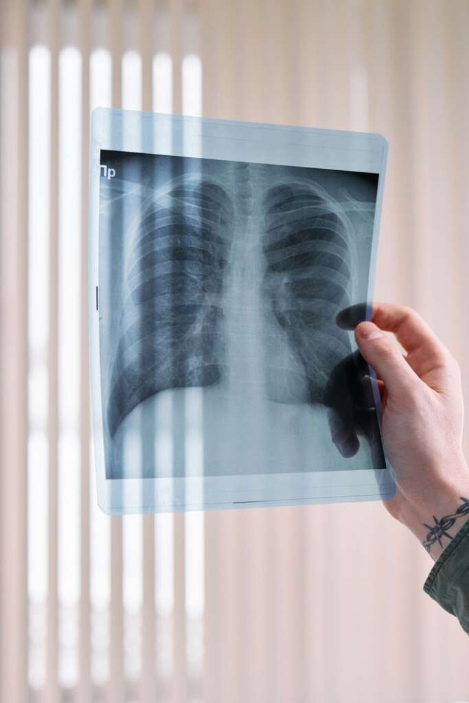 Fibrose pulmonar idiopática: o que avaliar quando o plano nega nintedanibe ou pirfenidona