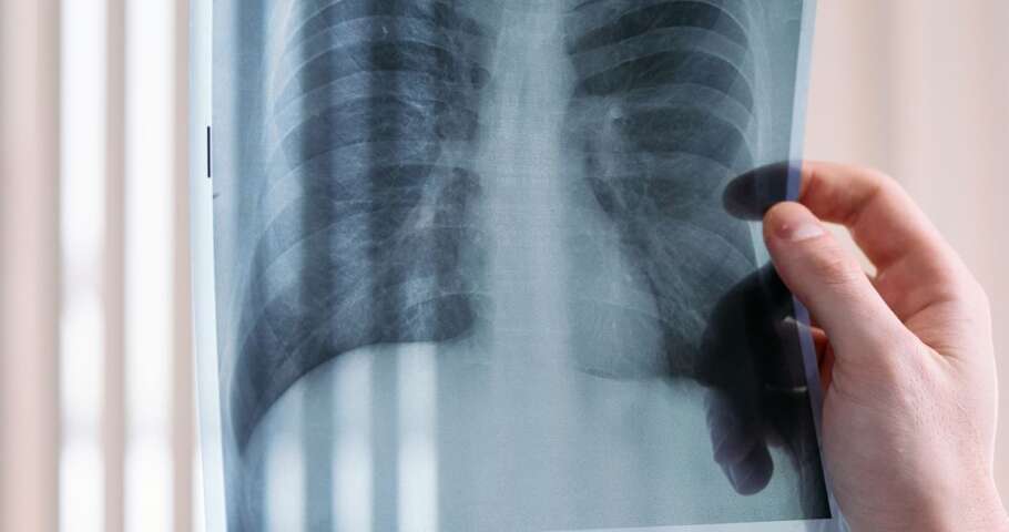 Médico observa radiografia de tórax durante avaliação pulmonar